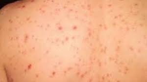 It can itch, sting, burn, or hurt. Meningitis Symptoms And Advice Calendar Itv News