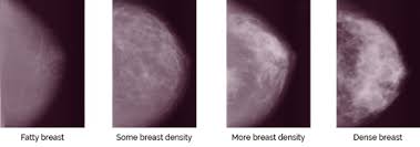 Breast Density On A Mammogram Susan G Komen