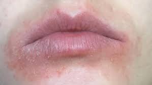trendy lip balm lawsuit claims allergic