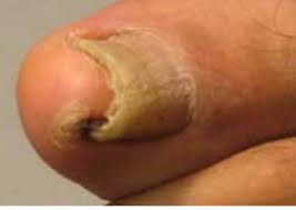 partial nail avulsion ingrown toenail