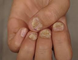 twenty nail dystrophy an overview
