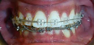 Check spelling or type a new query. How Much Do Braces Cost