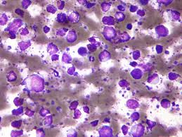 B Cell Lymphoma Wikipedia