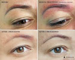 microblading removal permanent makeup