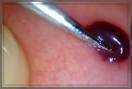 blood blister in your mouth causes and