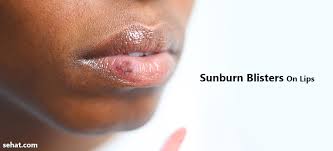 sunburn blisters on lips causes and