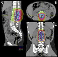 spinal cord ependymoma in children