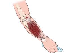 Picture of forearm muscles and tendons. Tennis Elbow Lateral Epicondylitis Orthoinfo Aaos