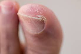 ingrown toenail or onychophosis