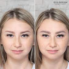 permanent makeup laser removal