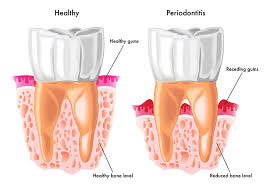 treatment of periodonis australian