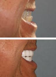When the lower jaw, or mandible, has not developed properly, surgery can help improve the shape. Underbite And Overbite Correction Without Surgery