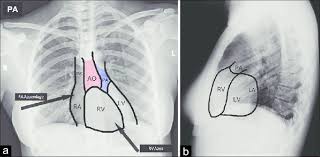 It first appears too complicated to read the chest xrays because we barely know what. Normal Chest Pa And Lat Radiographic Views Chest X Ray A Download Scientific Diagram