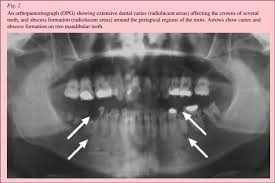 Can wisdom tooth pain go away on its own? Management Of Acute Dental Pain A Practical Approach For Primary Health Care Providers Australian Prescriber