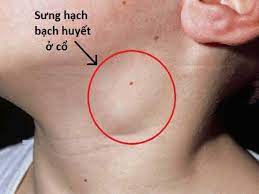 swollen lymph nodes and glands in