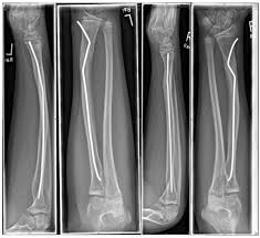 pre bending of an intramedullary nail