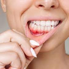 mouth ulcers causes treatment and