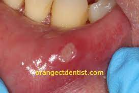 aphthous ulcers canker sores