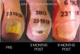 laser toe fungus removal in toronto