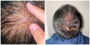 pimples after hair transplant are they