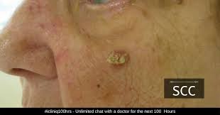 what is squamous cell carcinoma scc