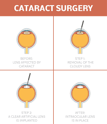 the 4 types of cataract lenses eye