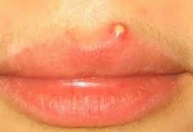 whiteheads on lips around lip line