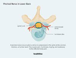 pinched nerve in lower back causes