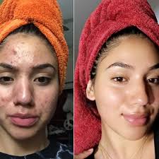 Find a list of current medications, their possible side effects, dosage, and efficacy when used to treat or reduce the symptoms of acne. Teen Shares How She Cleared Her Severe Acne Using Cheap Products Gma