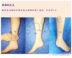 中医特色传统技术（一）】腕踝针：一针帮你止“痛” - 特色技术- 江门市中心医院