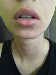 are lumps after lip fillers normal photo