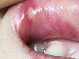mouth ulcers types causes symptoms