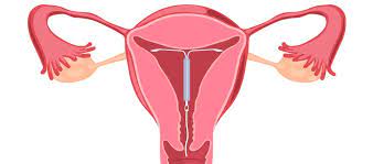 all about iuds what you need to know