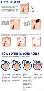 Knowing The Type And Severity Of Your Acne Presently And In