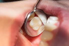 If you do nothing, you're heading for some lost teeth. My Tooth Feels Loose Emergency Dentist Boyles General Dentistry