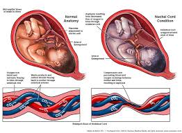 Umbilical Cord Blood Gases And Birth Asphyxia