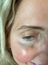 treatment for crepey skin under eyes i