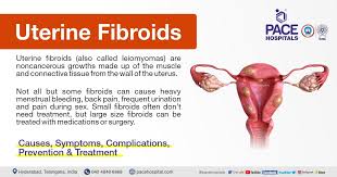 uterine fibroids symptoms causes