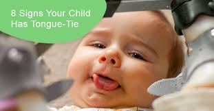 8 signs your child has tongue tie