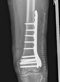 distal femur fractures the bone