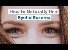 how to naturally heal eyelid eczema