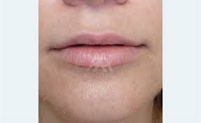 mira clinic lip augmentation in