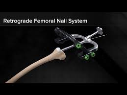 retrograde fem nail system surgical