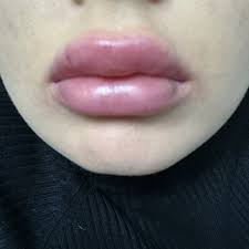 lip injections