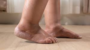 4 signs your swollen feet might require