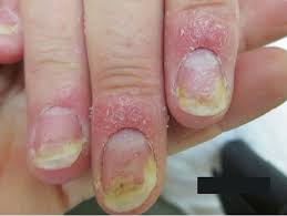 nail psoriasis causes symptoms