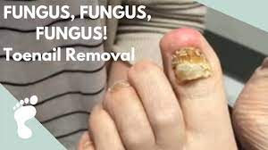 fungus fungus fungus toenail removal