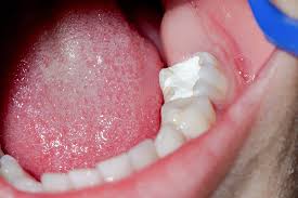 dental filling for a cavity