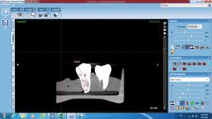 endodontic length measurements using