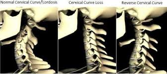 whiplash chiropractor loss of cervical